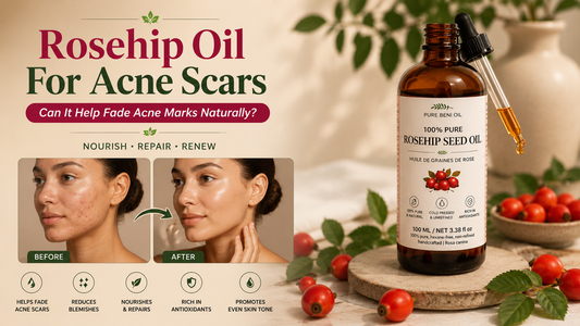 Rosehip oil bottle with rosehip berries on a soft linen background — rosehip oil for acne scars