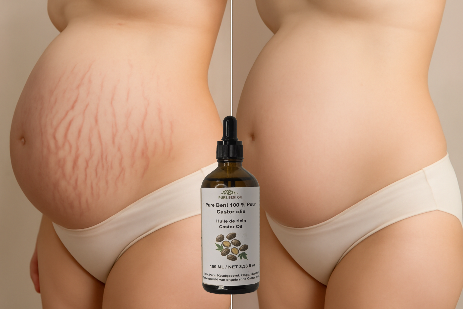 for stretch mark